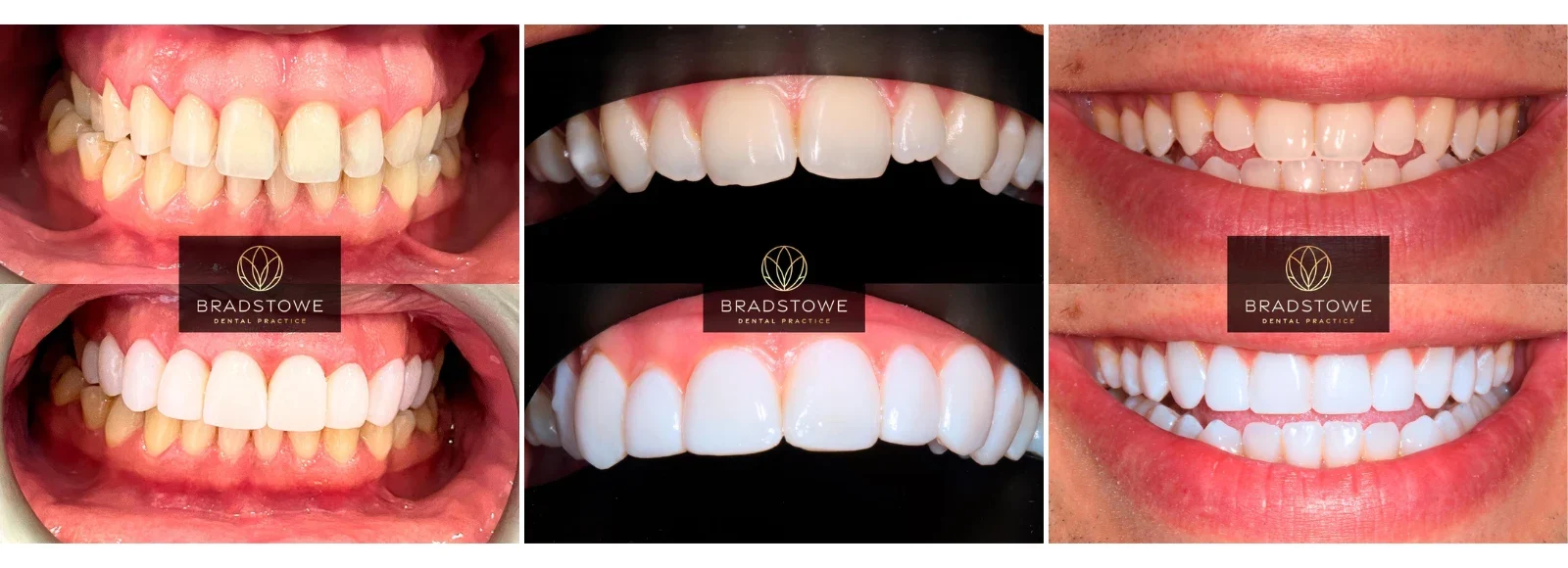Composite bonding before and after results at Bradstowe Dental showing transformed smile