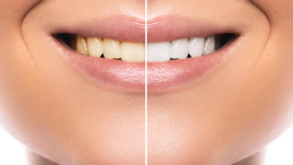 split screen of teeth whitening before and after bradstowe dental practice