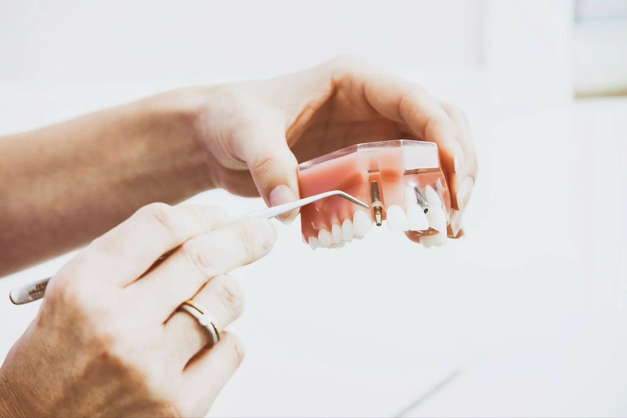 Dental Implants Cost in Woking