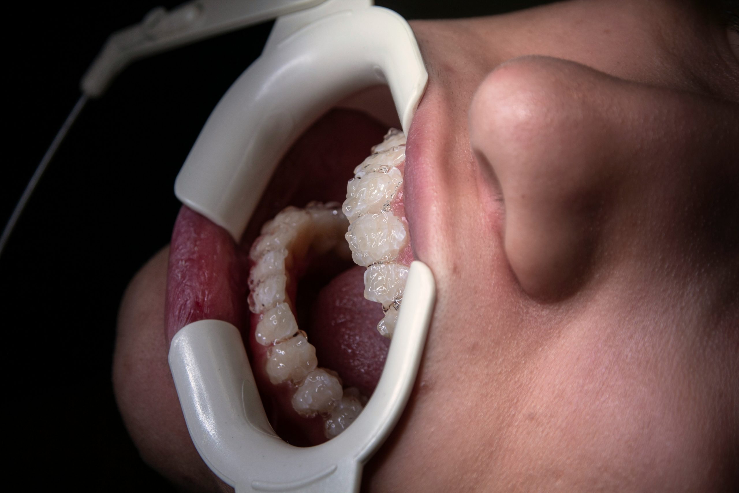 professional in-chair teeth whitening treatment at Bradstowe Dental Woking