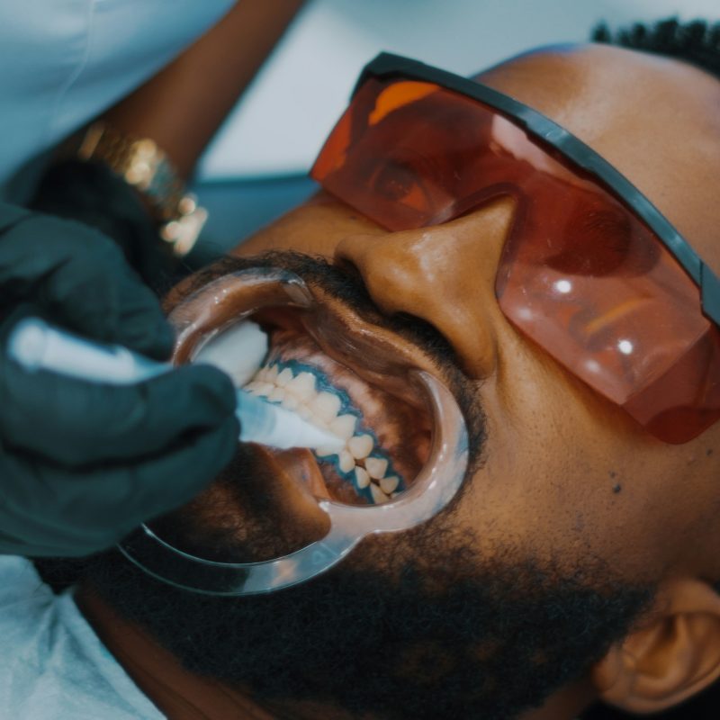 how long does teeth whitening last — patient receiving professional in-chair whitening treatment