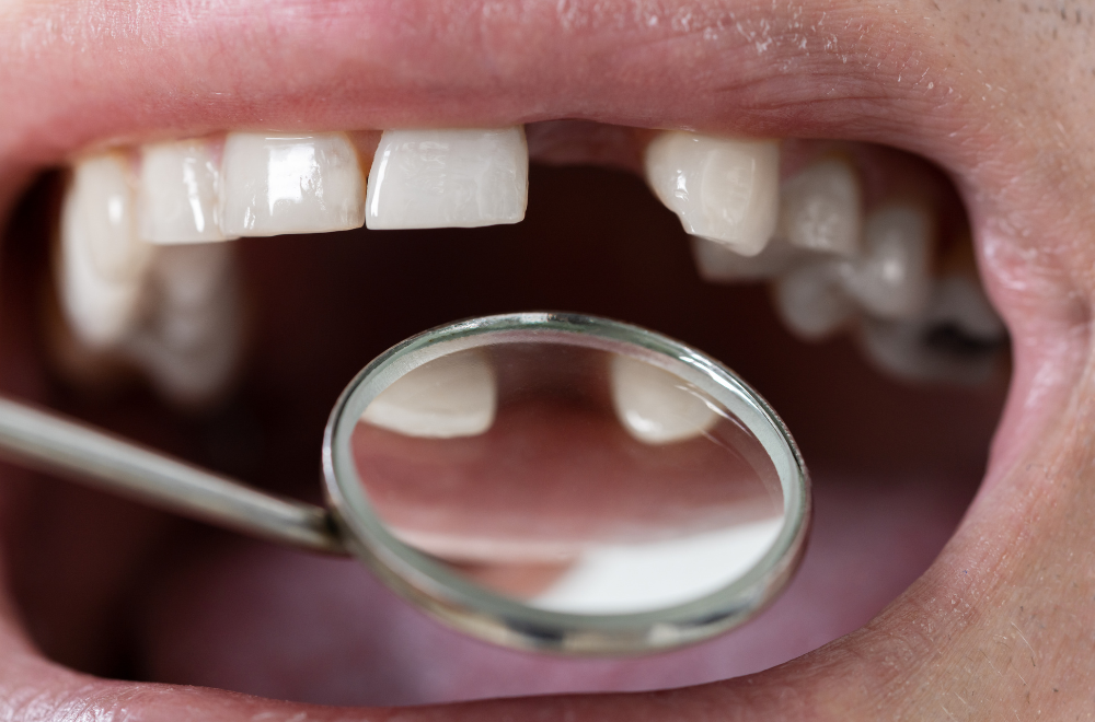Close-up of a patient's smile with a dental mirror reflecting healthy teeth, representing All-on-4 dental implant results at Bradstowe Dental in Woking
