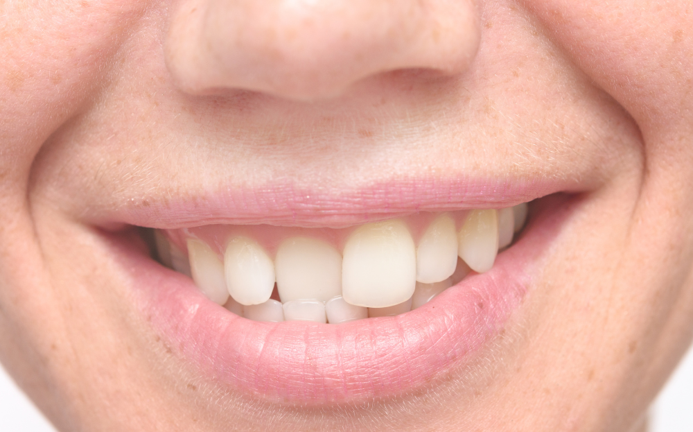 Close-up of crowded teeth before Invisalign treatment at a private dentist in Woking