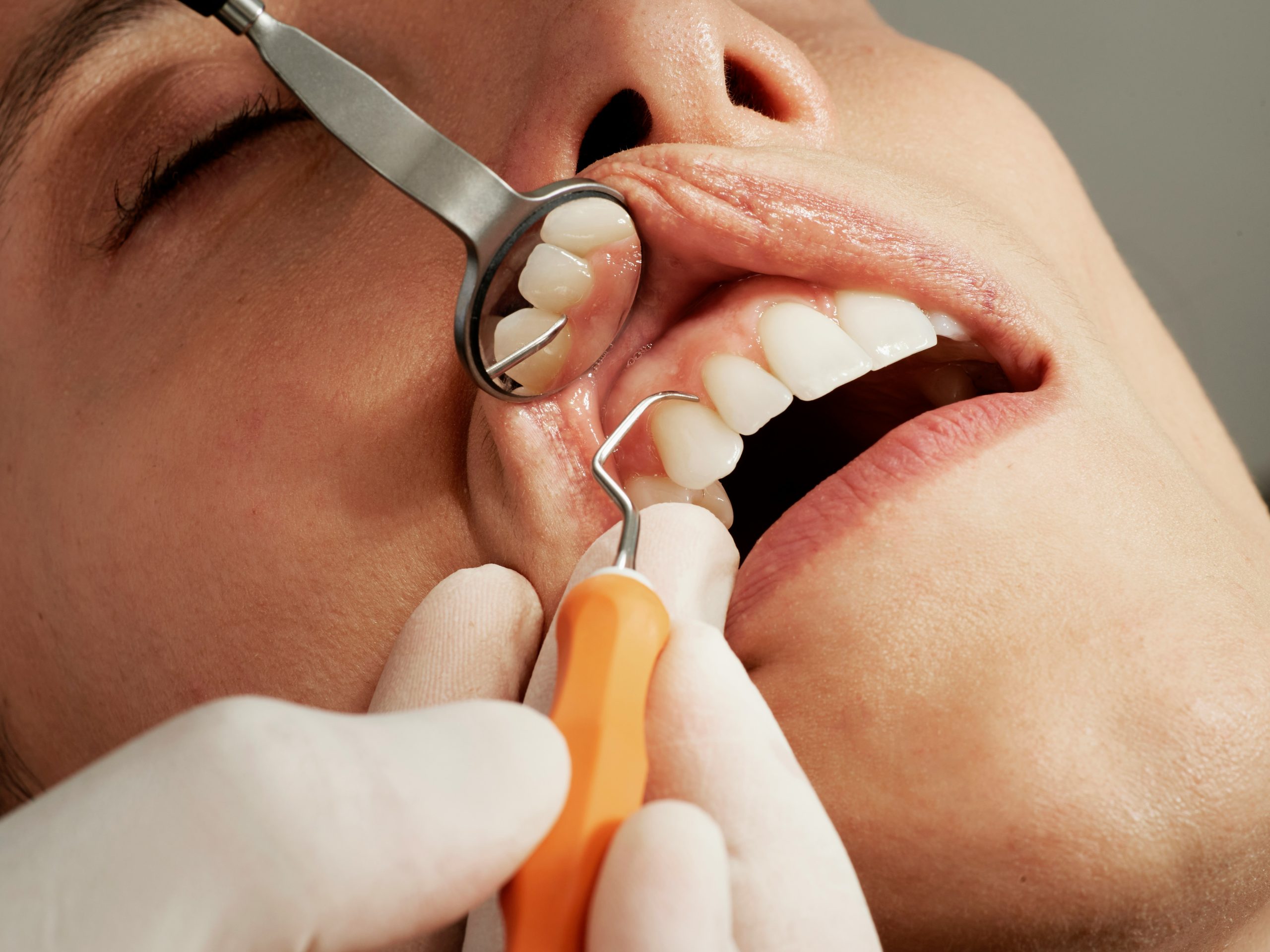 Close-up of a dentist examining a patient's teeth before dental implant surgery