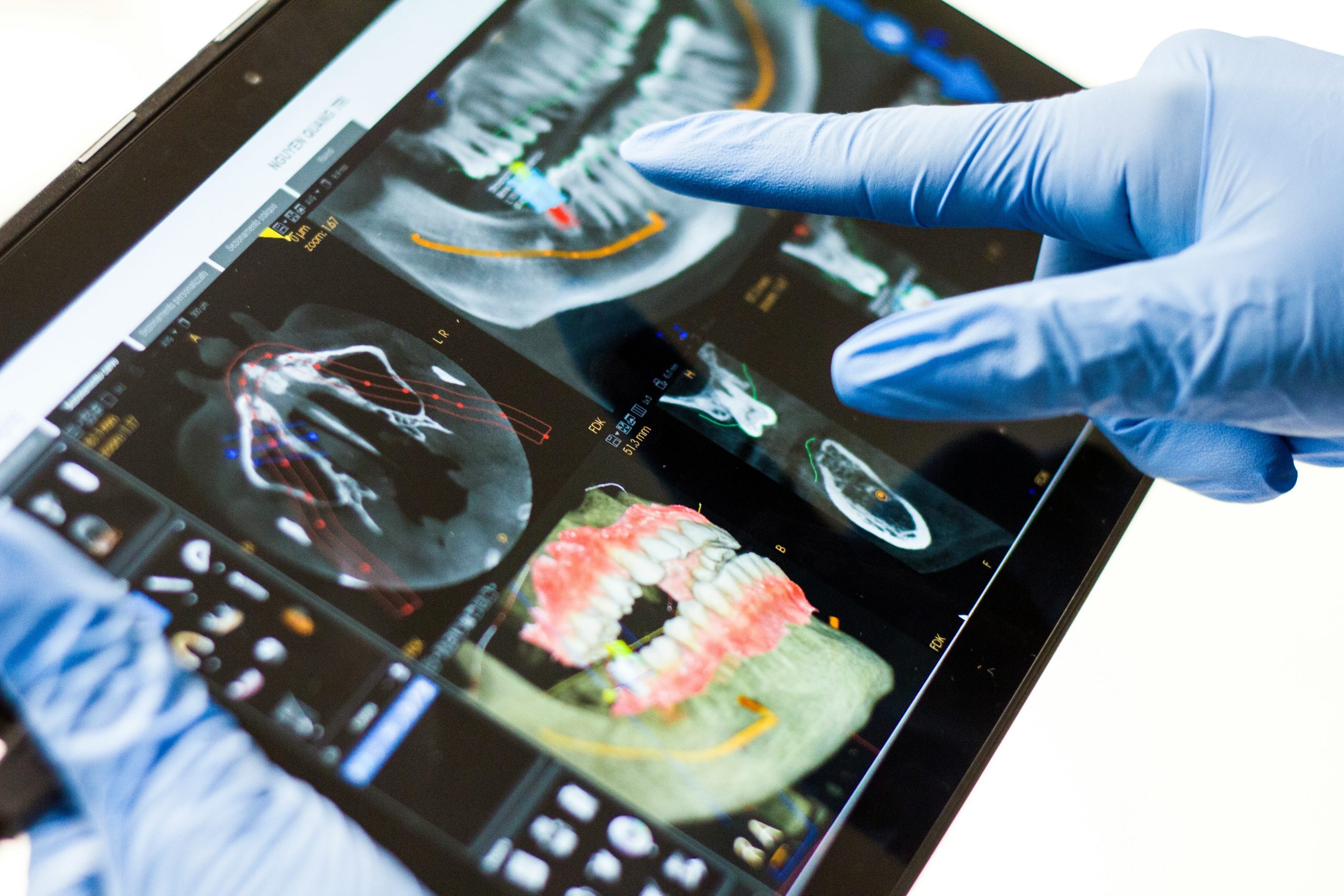 Dentist pointing at digital jaw scans used to plan dental implant treatment